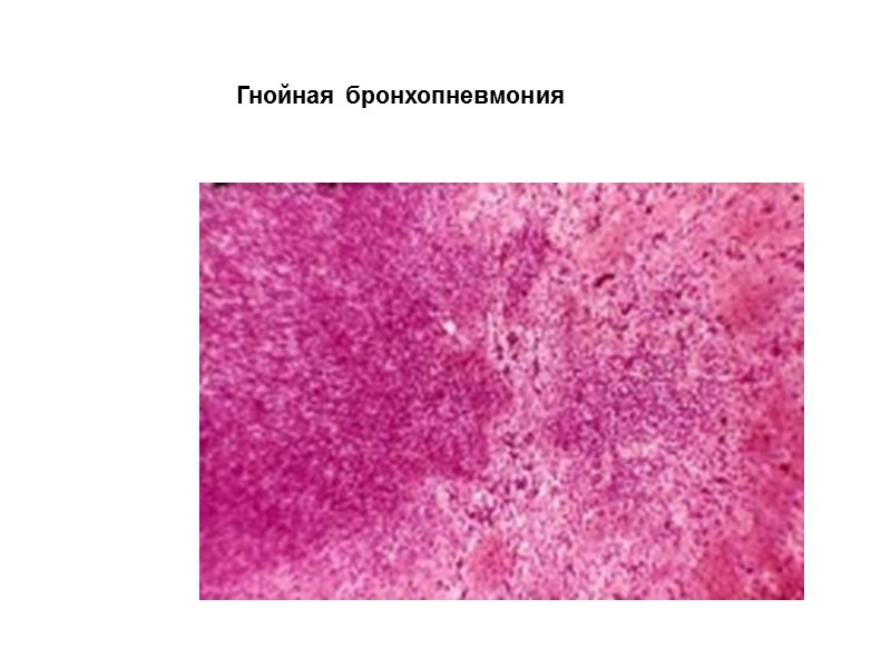 Гнойная бронхопневмония